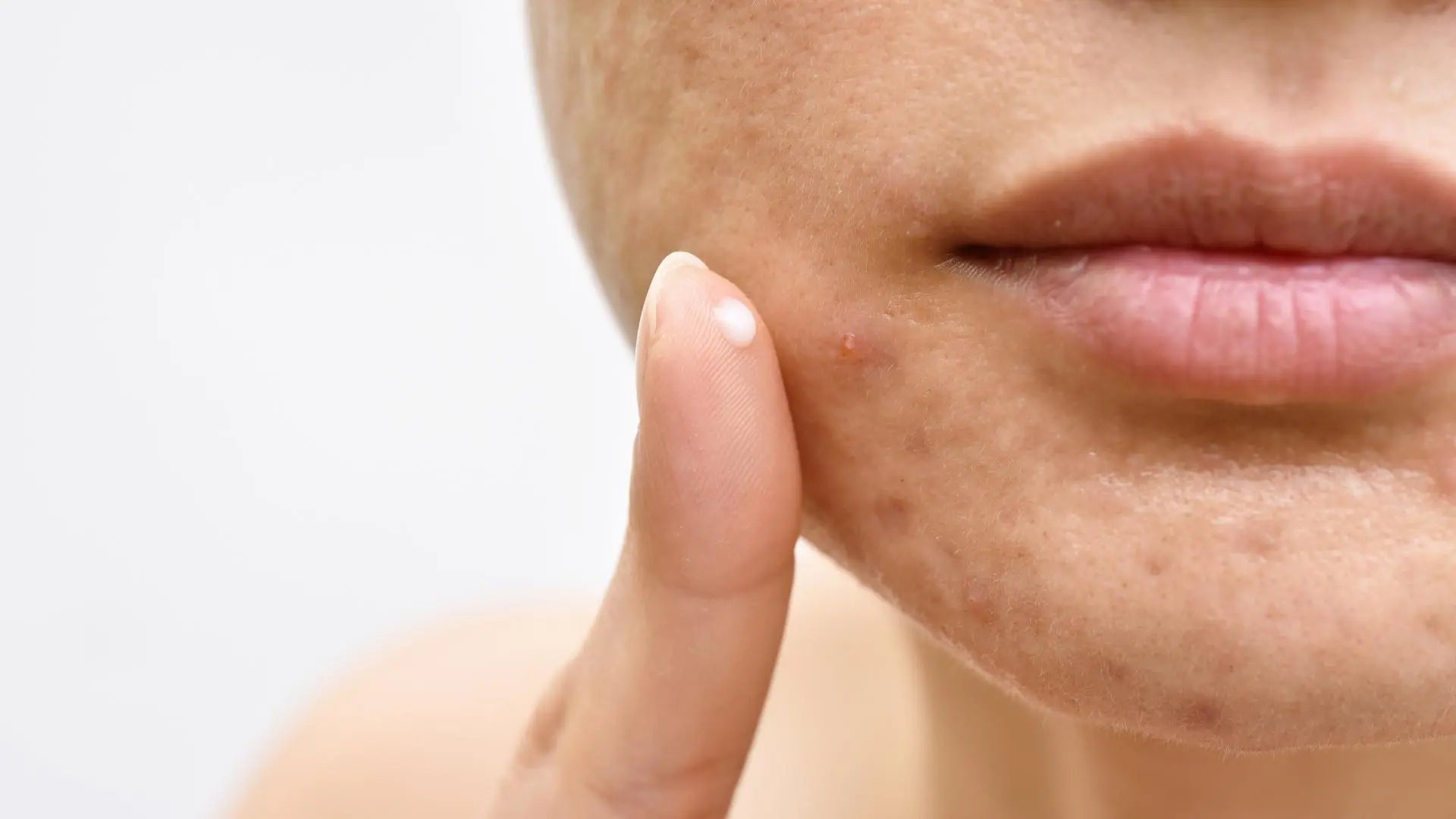 A Comprehensive Acne Treatment Guide: Your Path to Clear Skin - Manggo Skincare